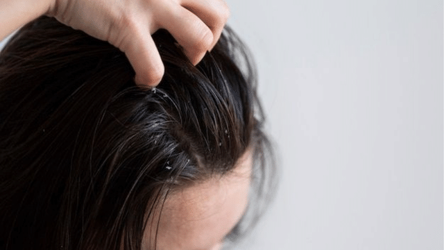 5 easy hacks to remove dandruff from your hair